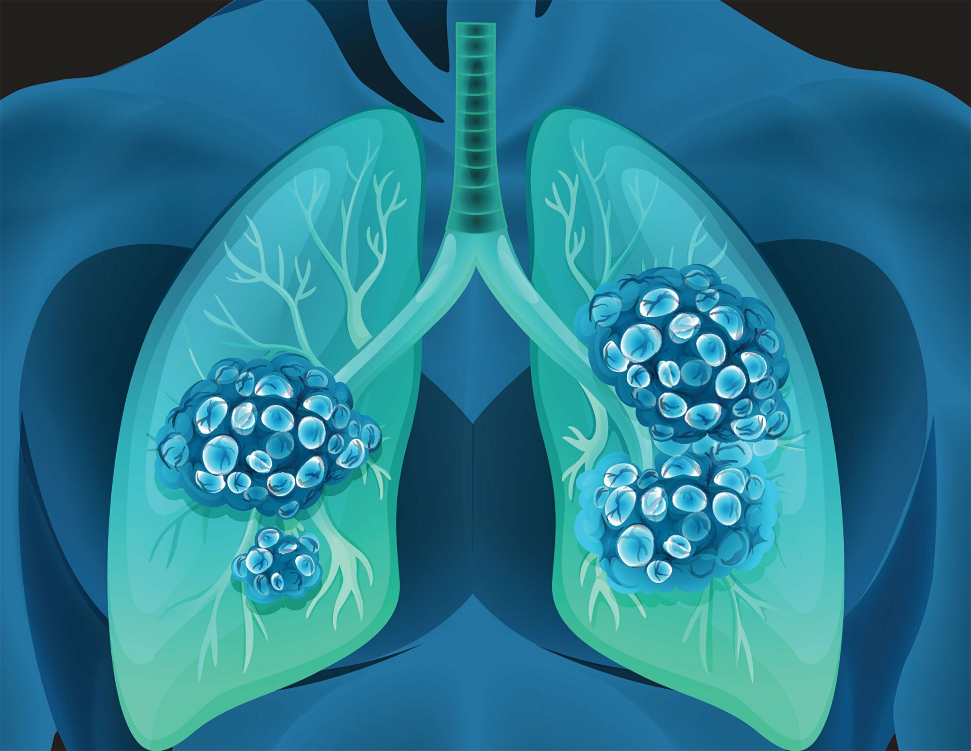 AI detects new breast cancer sub-types and remedies 42