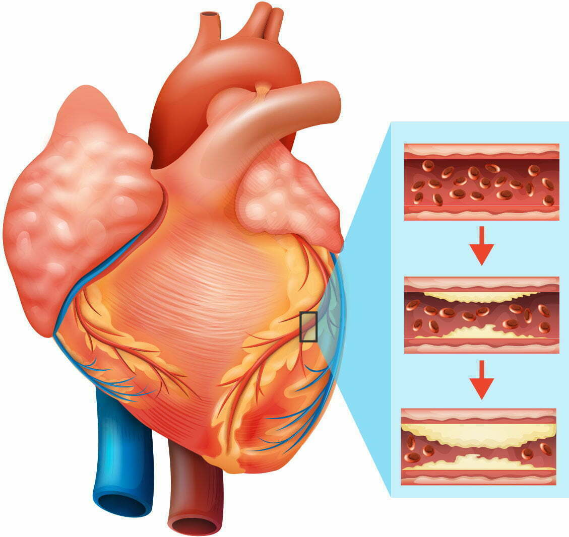 Silent coronary heart attack: Four signs you may be having a silent coronary heart assault 16