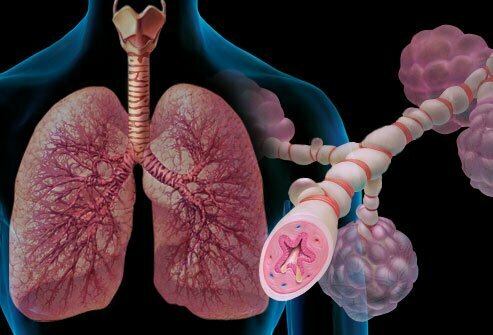 One-third of all new early life bronchial asthma instances 12