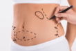 Things To Have In Mind Before Getting Liposuction 16