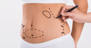 Things To Have In Mind Before Getting Liposuction 2