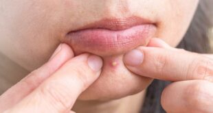 How To Get Rid Of A Pimple Scab In Just 1 Night? 1