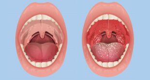 Secret behind white spots on tonsils 9