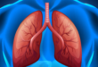 Understanding Multifocal Pneumonia: Symptoms and Treatment 16